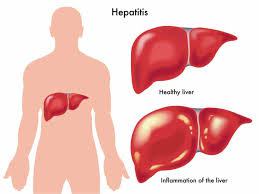 cara mengobati hepatitis